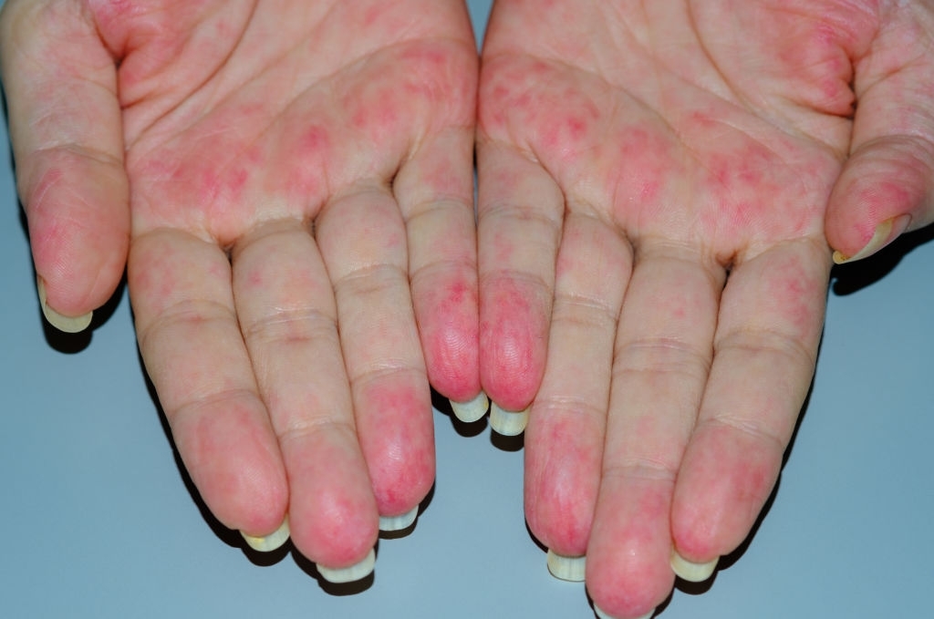 Hands showing red rash or irritation on the palms.